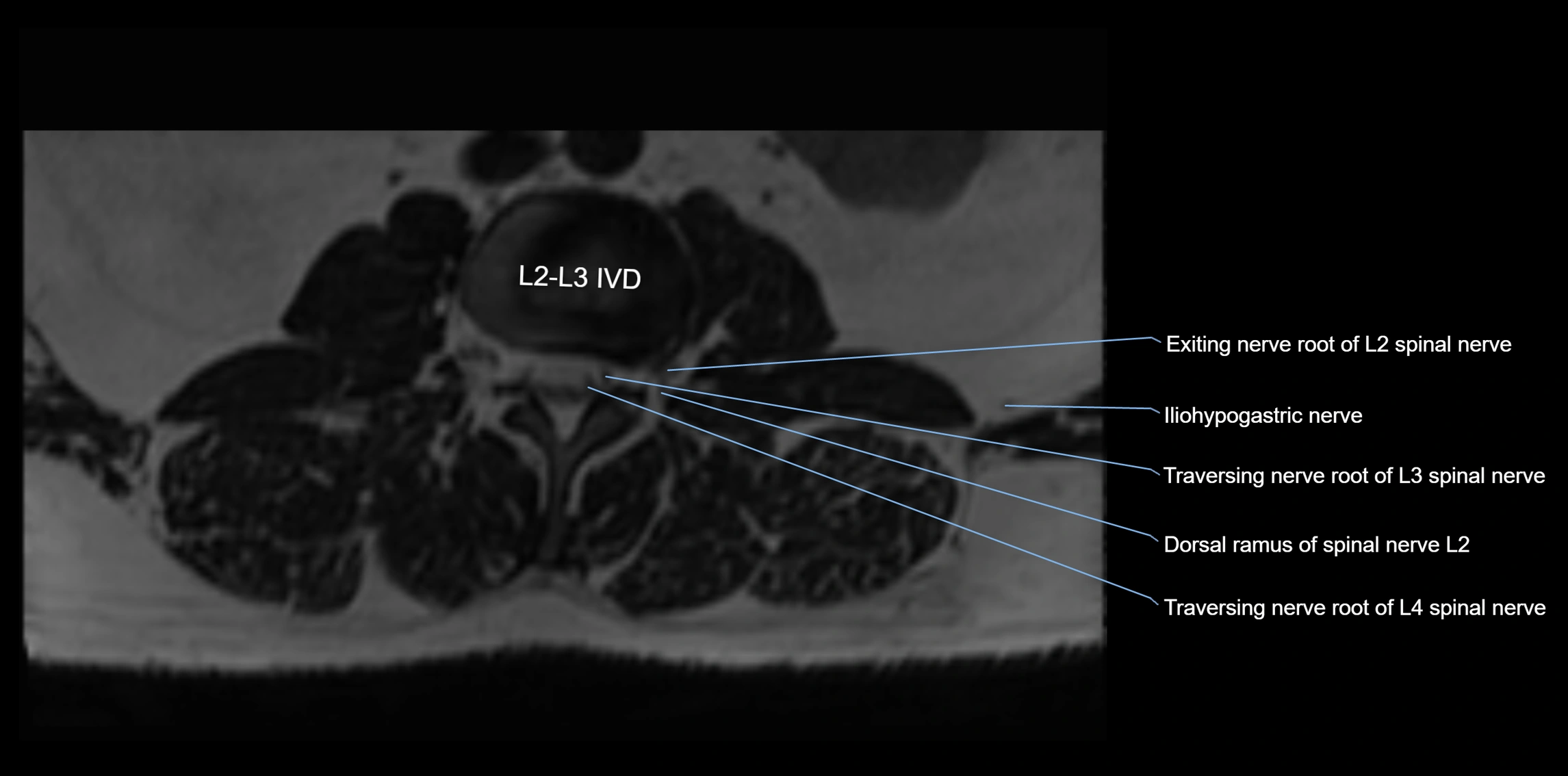 MR lumbosacral plexus axial cross sectional anatomy 3T  radiology  image-img-1008001-00009.webp
